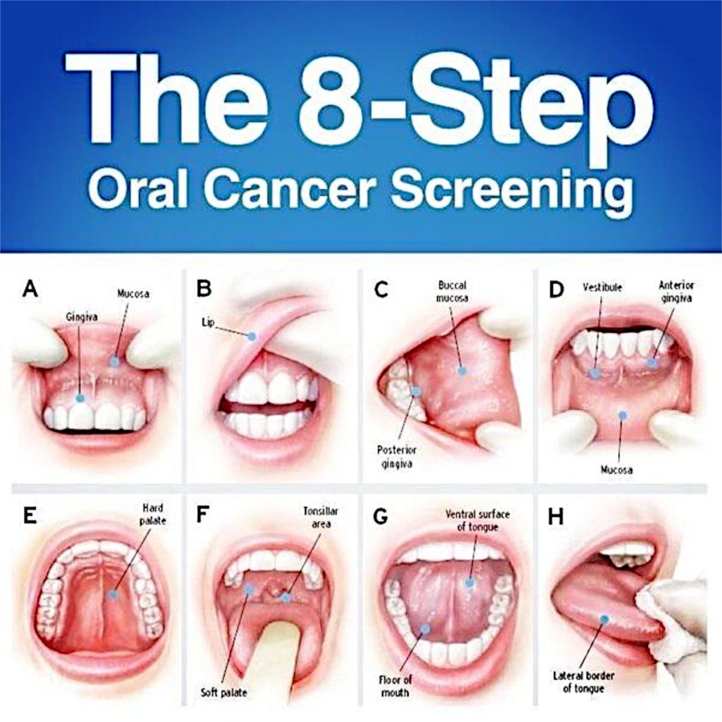 These DSOs Take a Stand Against Oral Cancer Group Dentistry Now