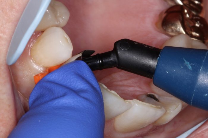 Fusion Matrix System Case Report: Anterior Matrix Systems Essential to Provide Proper ...
