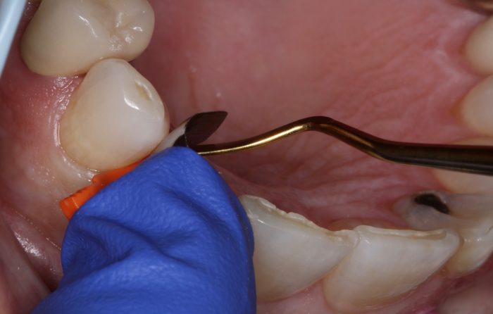 Fusion Matrix System Case Report: Anterior Matrix Systems Essential to Provide Proper ...