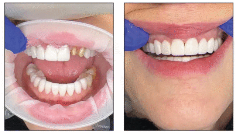 dental bonding restorative dentistry DSO Kerr