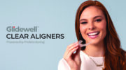 clear aligners
